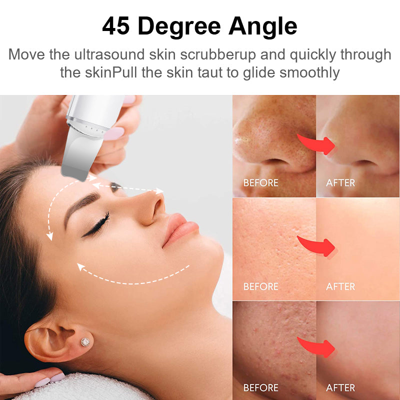Xiaomi Mijia Ultrasonic Skin Scrubber Vibration Face Spatula Blackhead Remover Shovel Clean Cavitation Peeling Facial Lifting - Skin Scrubber - L'CareSkin